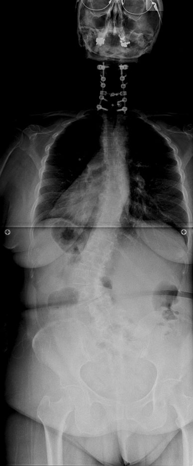 Image of abnormal preoperative adult degenerative scoliosis
